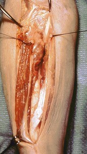 Natural color photograph of dissection of the forearm, anterior view