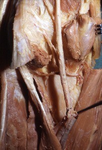 Natural color photograph of dissection of the popliteal fossa, showing the popliteal artery, with the popliteal vein and tibial nerve cut