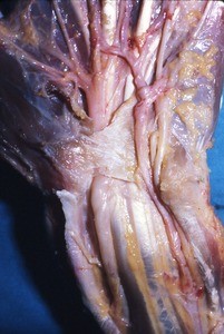 Natural color photograph of dissection of the superficial and deep palmar arches of the left hand, anterior view