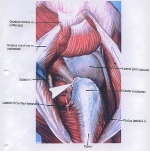 Illustration of right hip joint, lateral view, showing nerve, muscles and bones with gluteus maximus retracted, gluteus medius and minimus reflected. Arrow points to insertion of piriformis muscle upon greater trochanter