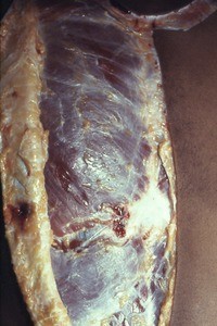 Natural color photograph of dissection of the thorax, anterior view, with the skin on the left side reflected to expose the deep fascia and superficial muscles of the thorax