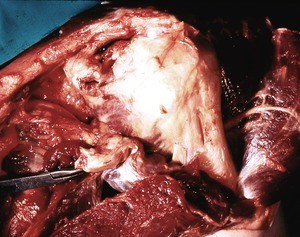 Natural color photograph of dissection of the left shoulder, anterior view, with muscles reflected to expose the surgical neck of the humerus and glenohumeral joint capsule