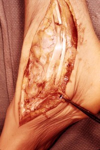 Natural color photograph of dissection of the right ankle, medial view, with the tibialis posterior t. and the flexor digitorum longus t. cut