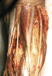 Natural color photograph of dissection of the popliteal fossa