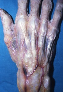 Natural color photograph of dissection of the dorsal surface of the right hand