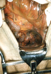 Natural color photograph of dissection of the lower abdominal and pelvic region, anterior view, showing viscera and associated mesentery