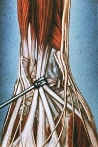 Illustration of radial styloid process, exposed by cutting of extensor retinaculum and retraction of common extensor digital tendons and extensor pollicis longus tendon, right hand, dorsal aspect