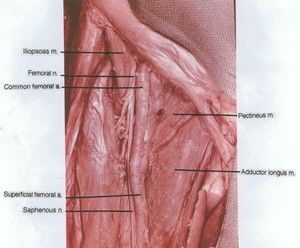 Natural color photograph of dissection of the femoral triangle, anterior view, showing the femoral artery and nerve with related structures