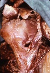 Natural color photograph of dissection of the right shoulder, anterolateral view, with the deltoid muscle reflected to expose the head and neck of the humerus