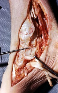 Natural color photograph of dissection of the right foot, medial view, with the tibialis posterior and flexor digitorum longus tendons reflected and the medial ligament of the ankle incised to expose underlying bone and connective tissue