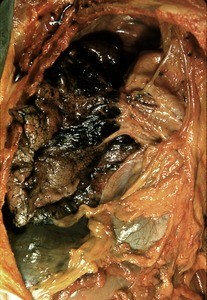 Natural color photograph of dissection of the right thorax, anterior view, with the rib cage removed to reveal the pleural cavity