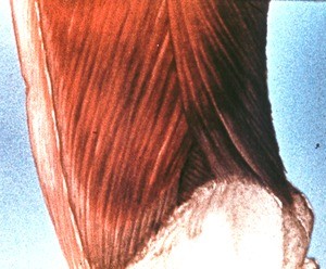 Illustration showing dissection of most superficial layers of left lateral abdominal wall: external abdominal oblique muscle and latissimus dorsi muscle