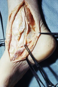 Natural color photograph of dissection of the right ankle, medial view, showing the tibialis posterior t. and the flexor digitorum longus t