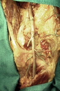 Natural color photograph of dissection of the popliteal fossa, showing the popliteal artery