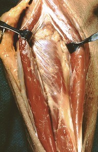 Natural color photograph of dissection of the forearm, showing musculature