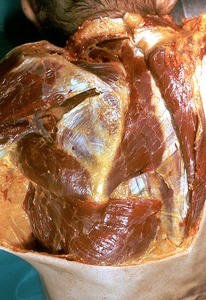 Natural color photograph of dissection of the back and left shoulder, posterior view, with the skin and trapezius muscle reflected to expose the underlying muscle structures
