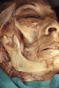 Natural color photograph of dissection of the face, right anterolateral view