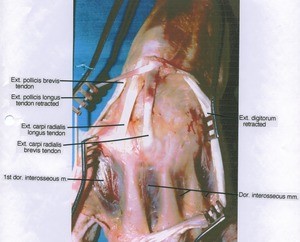 Natural color photograph of dissection of left wrist, posterior view, showing tendons and muscles with extensor digitorum tendons and extensor pollicis longus tendon retracted