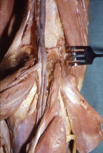 Natural color photograph of dissection of the popliteal fossa, showing muscles, nerves and vessels