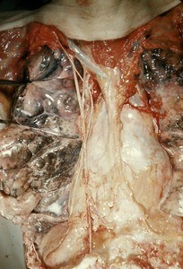 Natural color photograph of dissection of the thorax, anterior view, with the rib cage removed to reveal the lungs and mediastinum