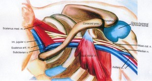 Illustration of dissection of the left axilla, anterior view, with most of the musculature dissected away to reveal the nervous and vascular structures