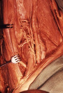 Natural color photograph of dissection of left thigh, anterior view, showing the femoral triangle