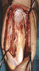 Natural color photograph of dissection of the forearm