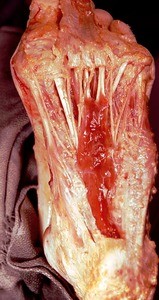 Natural color photograph of dissection of the plantar surface of the left foot