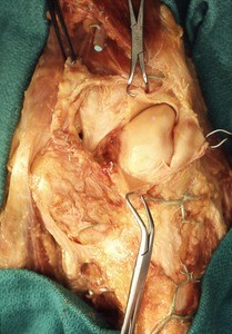 Natural color photograph of dissection of the right knee, posterior view, with the joint capsule incised to expose the lateral condyle of the femur