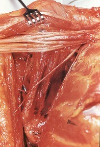 Natural color photograph of dissection of the shoulder, anterior view, showing the brachial plexus