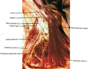 Natural color photograph of dissection of the axilla, emphasizing the major branches of the brachial plexus and related structures