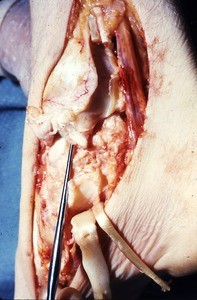 Natural color photograph of dissection of the right ankle, medial view