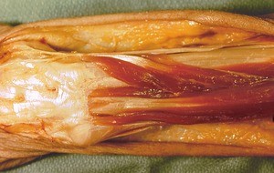 Photograph of dissection of the left forearm, posterior view, showing extensor retinaculum and the extensor muscles of the forearm and hand