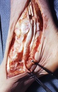 Natural color photograph of dissection of the the right ankle, medial view, showing the tibialis posterior tendon and the flexor digitorum longus tendon wrapping around the medial malleolus