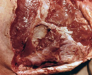 Natural color photograph of dissection of the left back, posterior view, with the trapezius, supraspinatus, and infraspinatus muscles partially reflected to reveal the scapula