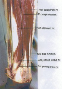 Natural color photograph of dissection of the left forearm, posterolateral view, showing extensor musculature