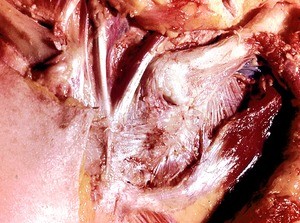 Natural color photograph of dissection of the the chest wall, overlying the sternum