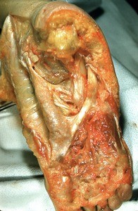 Natural color photograph of dissection of the plantar surface of the right foot