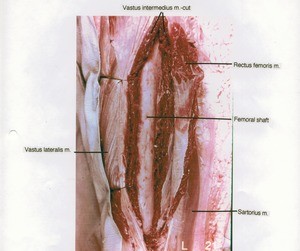 Natural color photograph of dissection of the right thigh, anterior view, the rectus femoris muscle has been cut and reflected to expose the femoral shaft