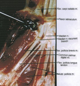 Natural color photograph of lateral portion of right hand and wrist, anterior view, showing ligament, muscles, tendons and nerves with the proximal end of the flexor pollicis brevis retracted