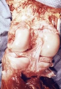 Natural color photograph of dissection of the knee, posterior view, showing the tibial table the condyles of the femur