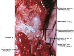 Natural color photograph of left knee, posterior view, showing muscles, bone, ligament, popliteal fascia and the tibial insertion of the Semitendinosus Muscle