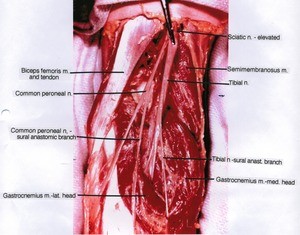 Natural color photograph of left knee, posterior view, showing muscles and the branches of the tibial and common fibular nerves