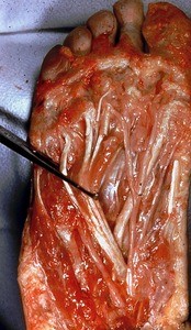 Natural color photograph of dissection of the plantar surface of the right foot