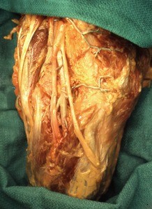 Natural color photograph of dissection of the popliteal fossa, showing the popliteal artery and vein