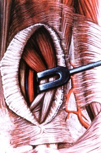 Illustration of dissection of surgical exposure of deep fibular (peroneal) artery and fibular (peroneal) nerve of right ankle, lateral view