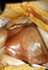 Natural color photograph of dissection of the abdomen, anterior view, showing viscera