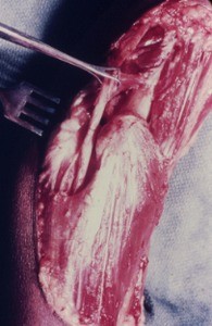 Natural color photograph of dissection of the left elbow, medial view, showing the ulnar nerve as it passes posterior to the medial malleolus