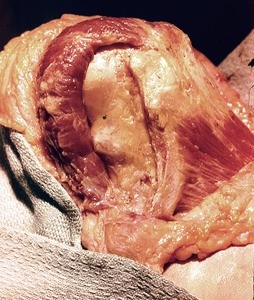 Natural color photograph of dissection of the right shoulder, superior view, showing bone and muscle structure