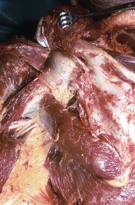 Natural color photograph of dissection of the left shoulder, posterior view, with the deltoid and rotator cuff muscles reflected to expose the head and surgical neck of the humerus